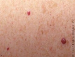 Red Moles on Skin