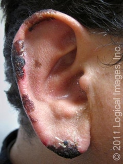 Cocaine Levamisole Toxicity