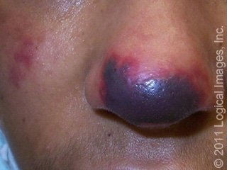 Health Alert: Cocaine Levamisole Toxicity