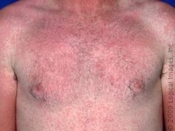 Can antibiotics cause a rash?