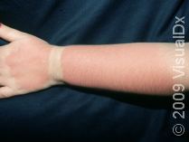 Simply Sunburn Solutions