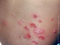 Impetigo in Adults