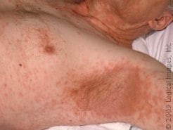 Rash Under Armpit
