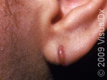 keloid on the face ear