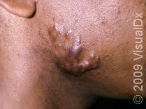 Got Melanin? Part Two in Our Series on Skin of Color