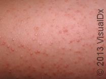 How to Improve the Pesky Bumps of Keratosis Pilaris, or “Gooseflesh”