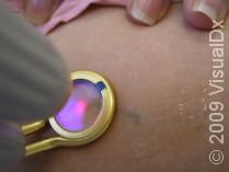 Day Four: Laser Hair Removal