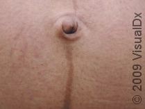 Linea Nigra, or the Dark Line of Pregnancy