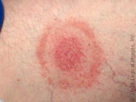 What could a bull’s-eye rash be?