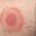 Lyme Disease