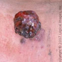 Melanoma