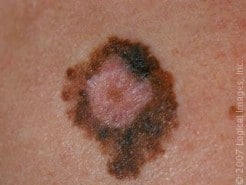 Dangers of Skin Cancer