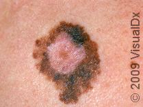 Types of Skin Cancer