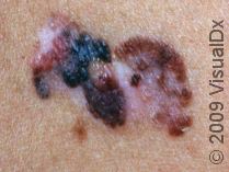 Why Isn’t Mohs Surgery Popular for Malignant Melanoma?
