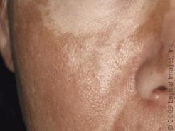 Melasma