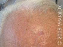 A Guide to Mohs Surgery