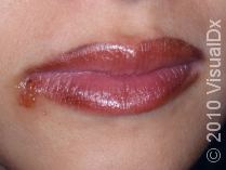 Healthy Lips for Valentine’s Day