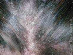 Common Back to School Skin Infections