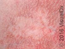 Poikiloderma of Civatte