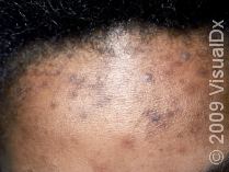 Post-inflammatory hyperpigmentation on the forehead from acne