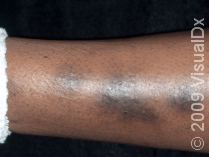 Dark Spots on Legs