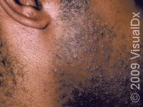 Pseudofolliculitis: Razor Bumps