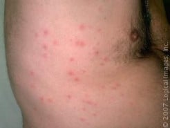 Hot Tub Folliculitis Caused by Bacterial Contamination