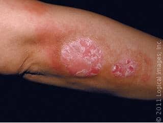 CNN asks “Can you eat to beat psoriasis?”