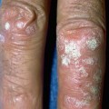 Psoriasis on fingers