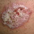 Psoriasis