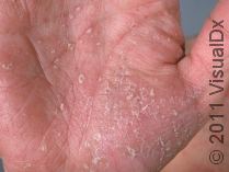 A Lifetime of Psoriasis