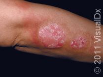 What is psoriasis?