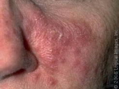 Understanding Rosacea