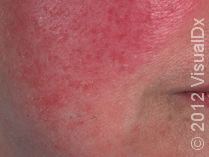 Rosacea Symptoms and Treatments