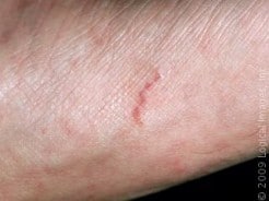 The Scabies Rash