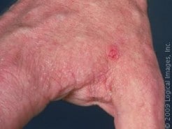 Preventing Scabies