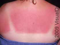 [365] Days of Summer . . . Top 5 Tips to Reverse Sun Damage