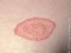 Top 5 School Skin Infections