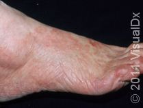 tineaPedisAthletesFoot_44544_med.jpg