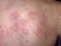 The Skin Rash and Itch of Hives