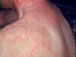 What Causes Hives?