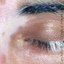 Vitiligo