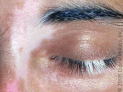 Vitiligo