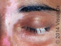 Vitiligo on the face