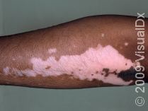 Vitiligo on the arm