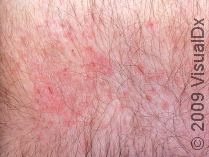 Treating Dry, Itchy Skin