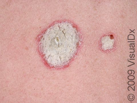 This image displays thick, white, scaly skin with redness underneath, typical of psoriasis.