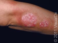 Psoriasis – Adult