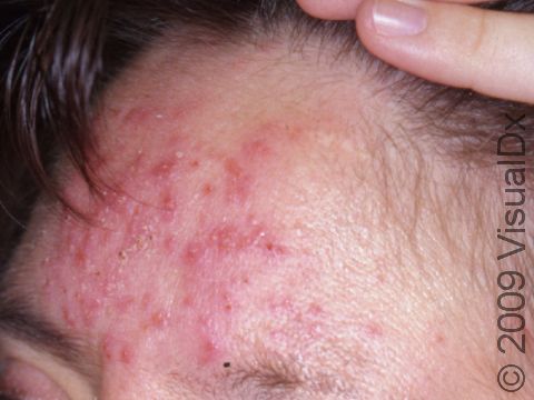The central forehead is often affected in severe rosacea with multiple pimple-like bumps.