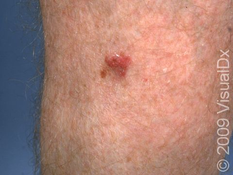 This red lesion, specifically called a plaque, on the leg is typical of a superficial squamous cell carcinoma.